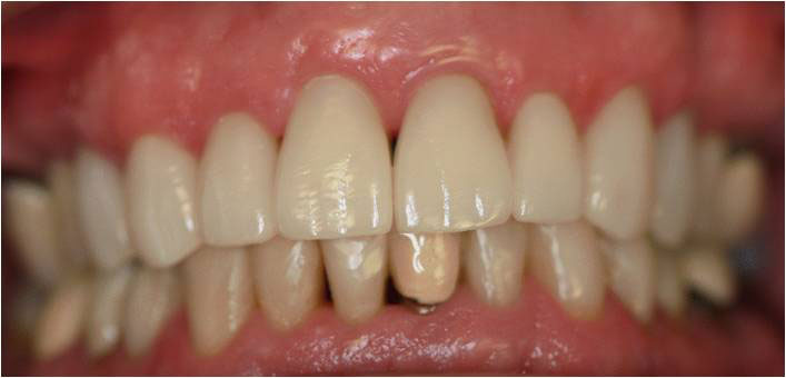The image shows a close-up of a person s teeth, emphasizing the crooked alignment and yellowing of the front teeth.