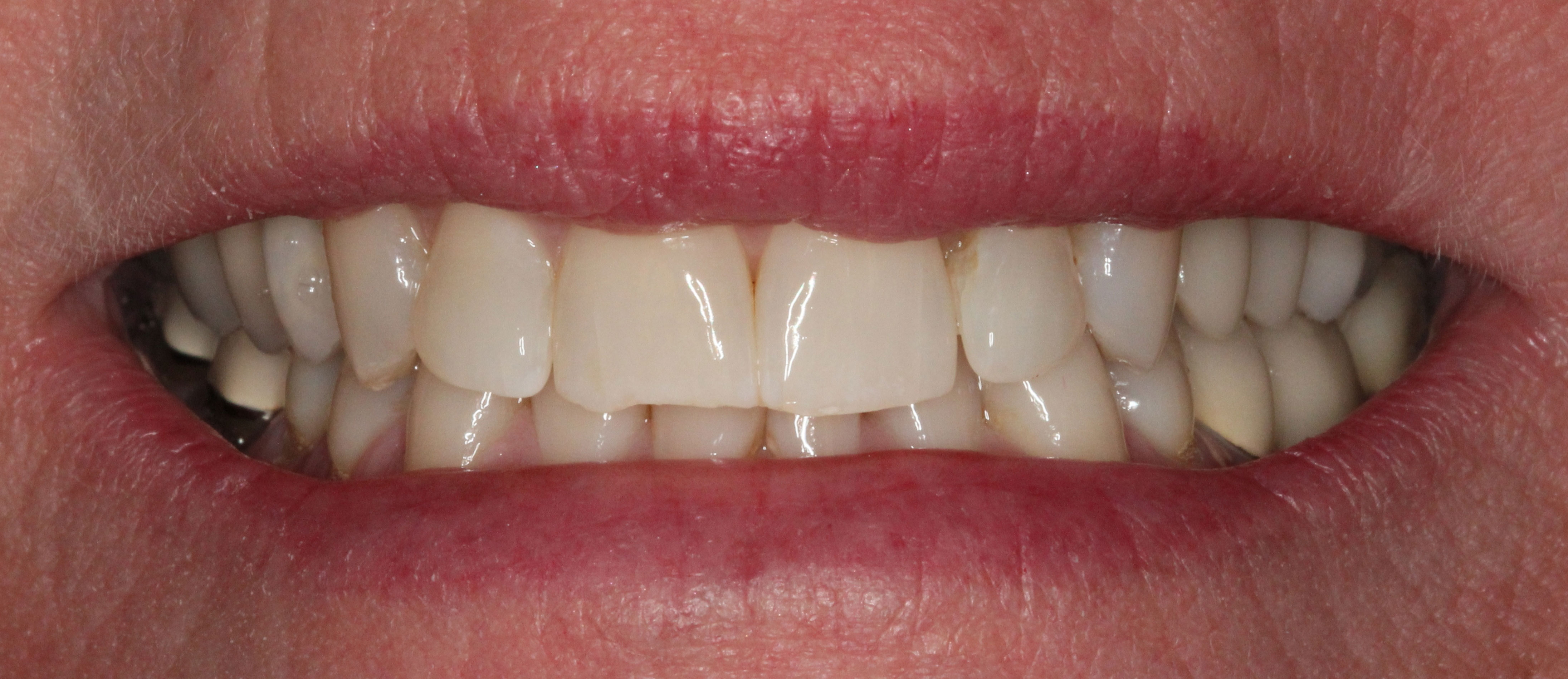 The image shows a close-up of a person's smile, featuring white teeth and a partial denture on the upper right side.
