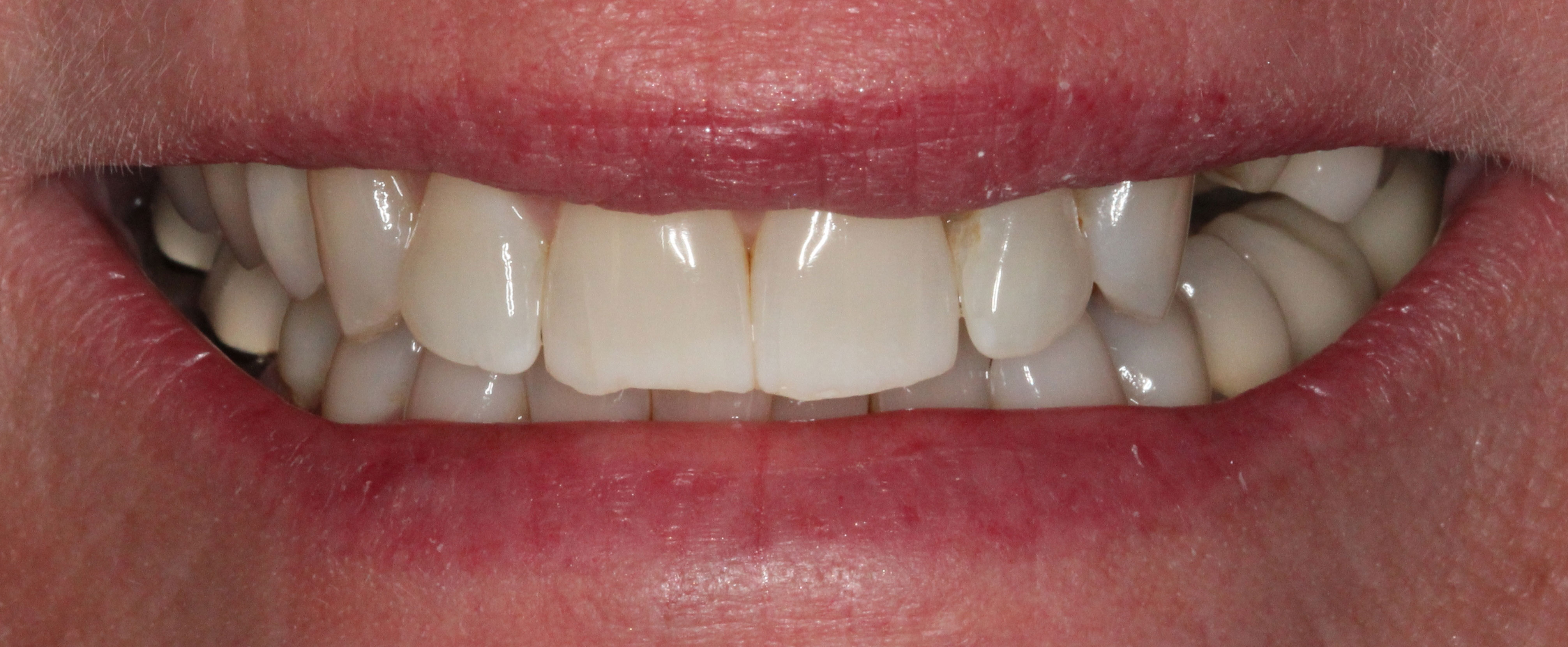 The image shows a person smiling with a set of white teeth, and the bottom part of their face is visible.