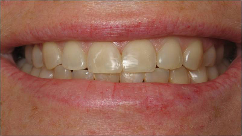 The image shows a close-up of a person s smiling face, focusing on their teeth and lips.