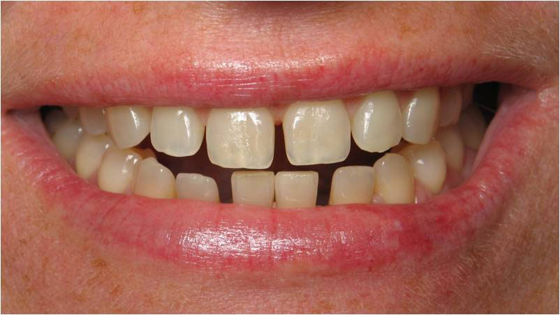 The image shows a close-up of a person s smiling face, revealing a set of teeth with one prominent tooth that appears to be chipped or broken.