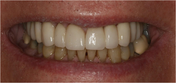The image shows a close-up of a person s mouth with teeth, likely for dental care or cosmetic purposes.