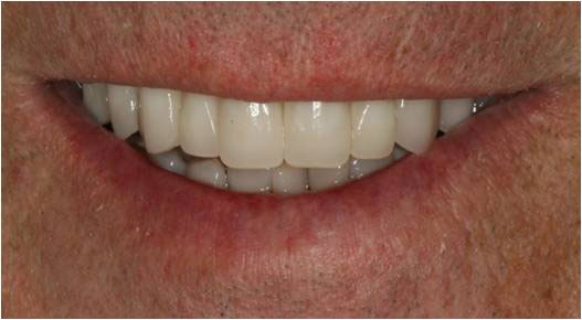 The image shows a close-up of a person s smile, featuring white teeth and a dimple on the chin.