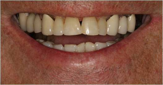 The image shows a close-up of a person s smiling mouth with teeth, revealing a dental implant.