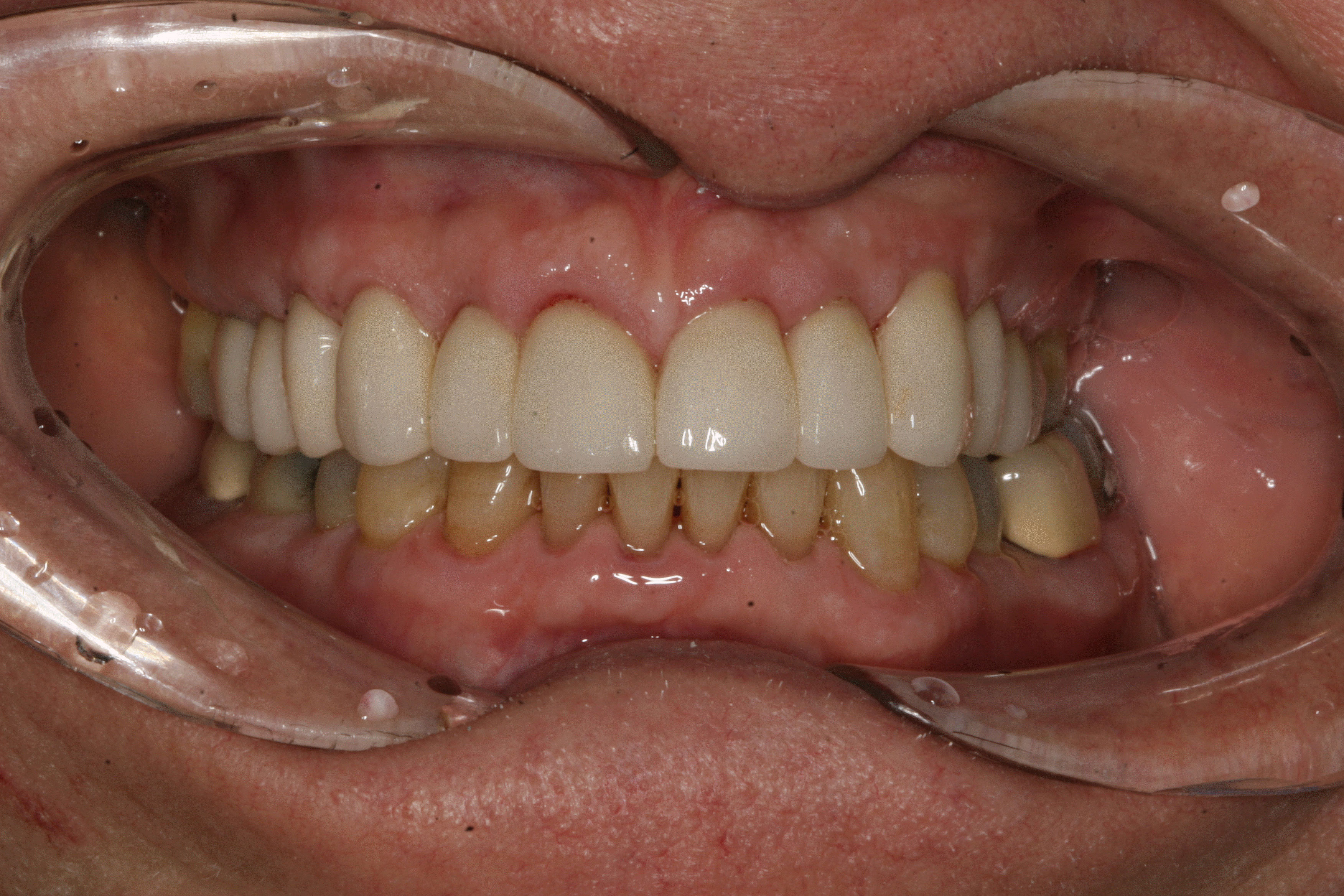 The image shows a person with a large, open mouth displaying yellowed teeth and an upper denture.