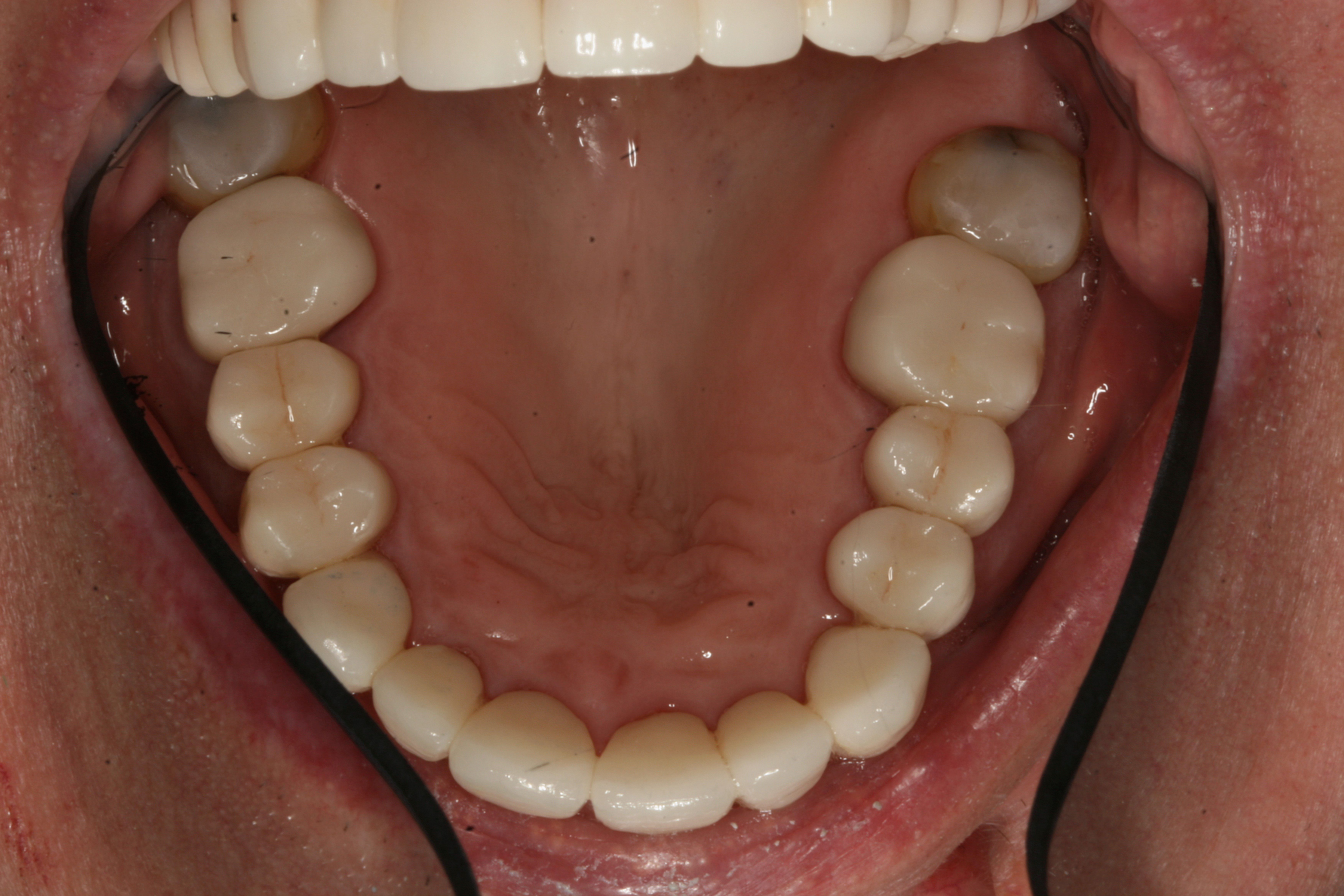 An open mouth displaying a set of teeth with visible dental implants and gumline.