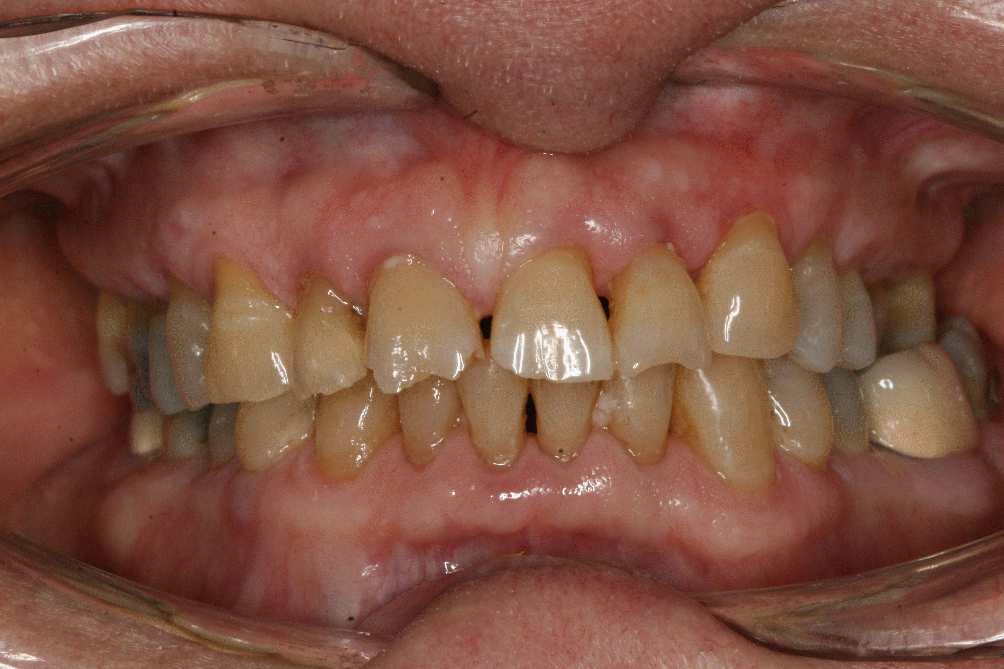 An image of a person's mouth with a set of teeth, showcasing an open smile displaying dental implants and braces.
