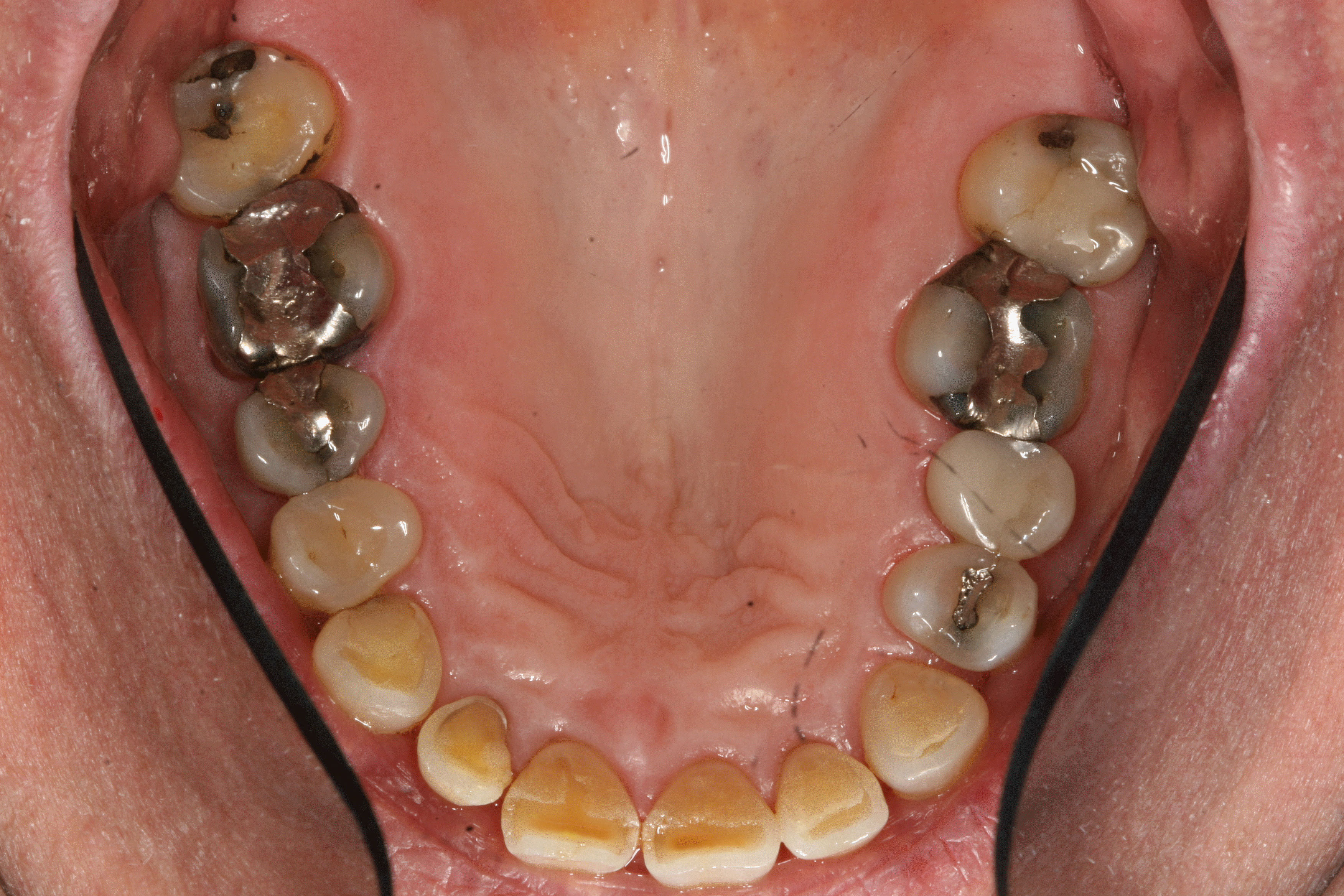 An open mouth with a set of teeth, showcasing the dental work and gums.