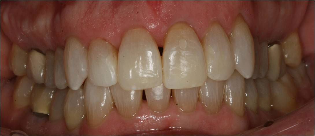 The image is a close-up photograph of a person s teeth, which appear to be in the process of being whitened or bleached, as indicated by the foamy substance on the teeth and gums.