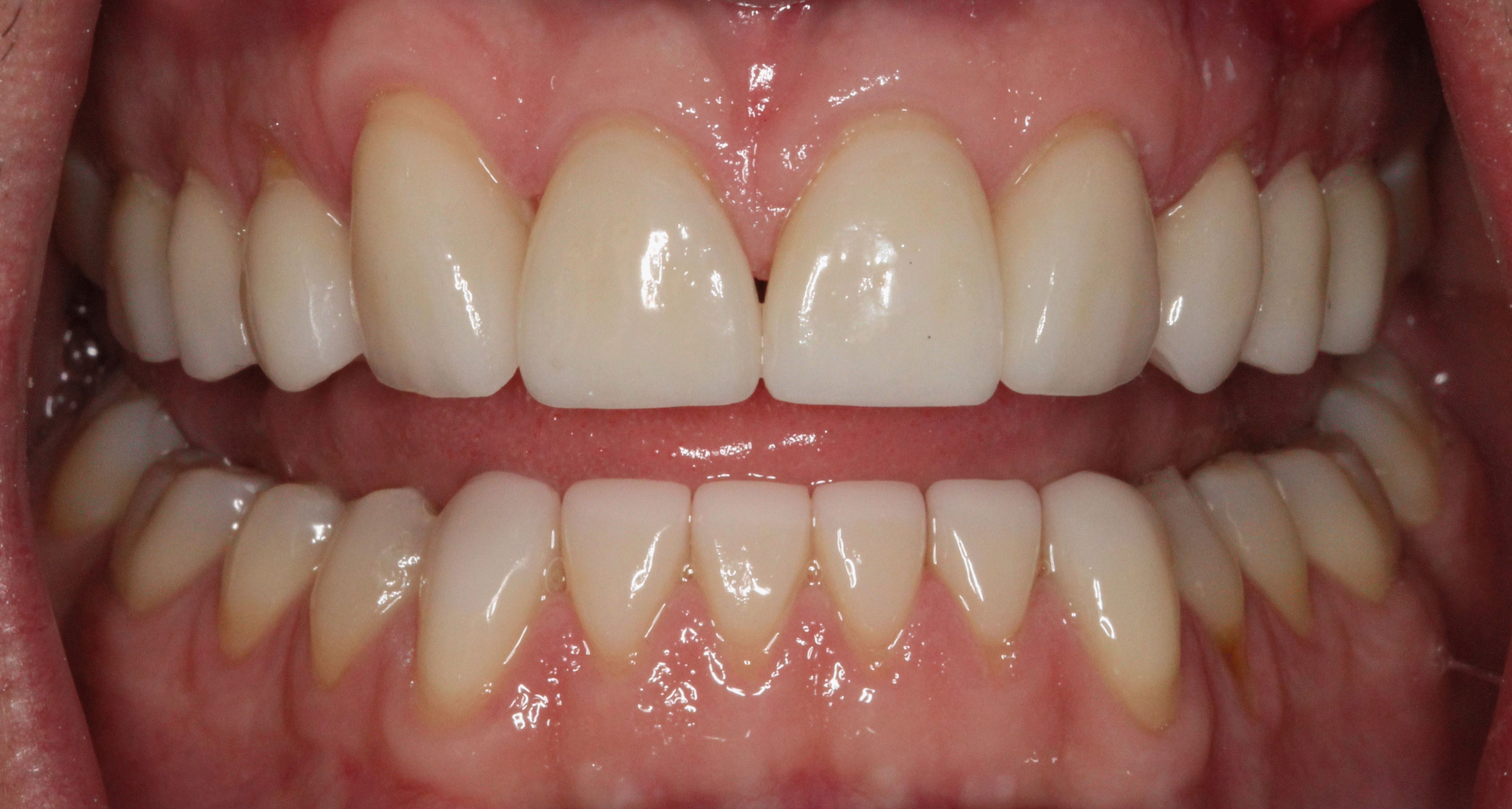 The image shows a close-up of a person's teeth with a focus on the upper front teeth, which appear to be in need of orthodontic treatment.