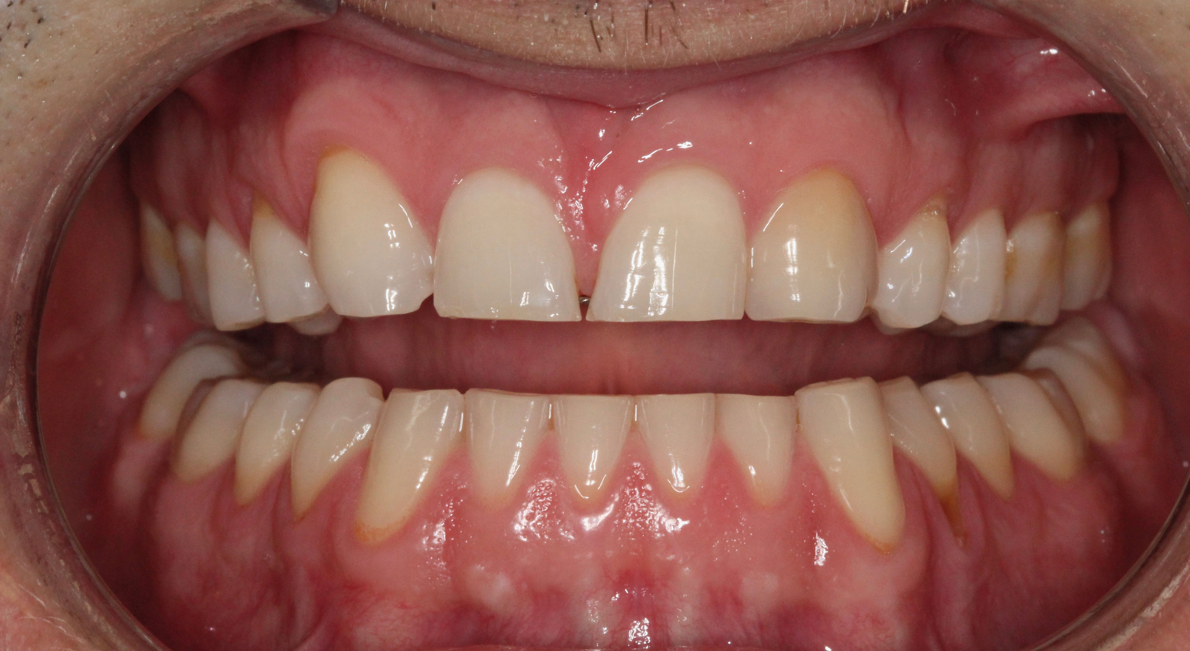 The image shows a person's mouth with teeth that appear to be in need of dental care, particularly cleaning or replacement.