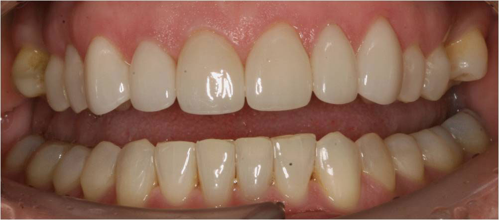 The image shows a close-up of a person s teeth with a focus on dental work, specifically a large gap between the front teeth and stained enamel.