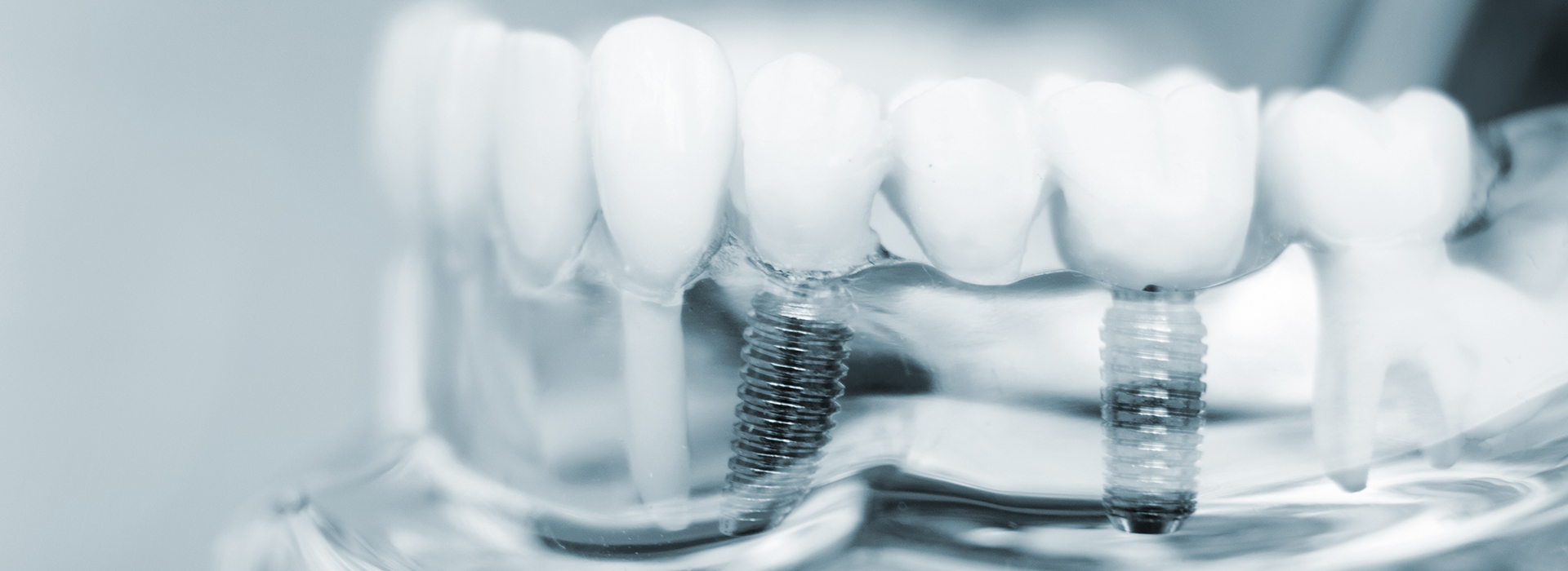 The image shows a close-up of multiple teeth with visible braces, set against a blurred background that appears to be the interior of a dental clinic or laboratory.